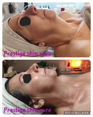 Ringiovanimento viso senza chirurgia
